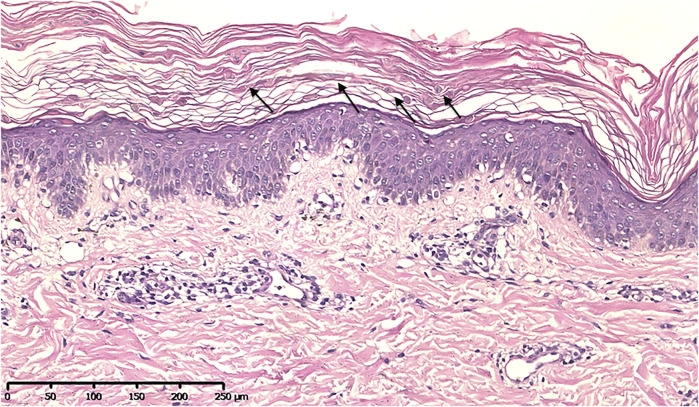 变异性红斑角化症佳学基因强