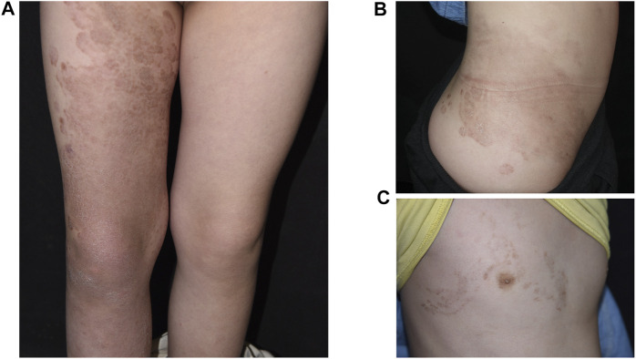 变异性红斑角化症