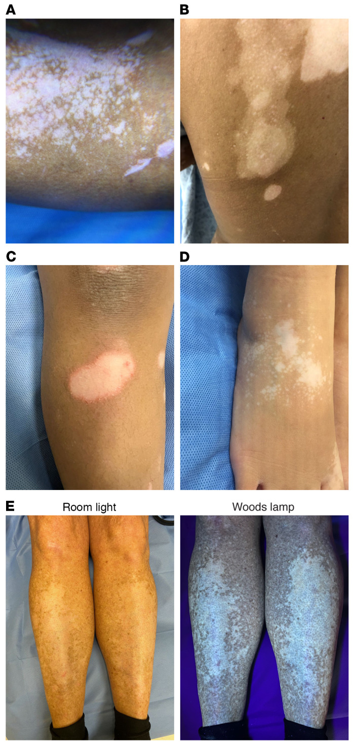 图2:白癜风的活化区域