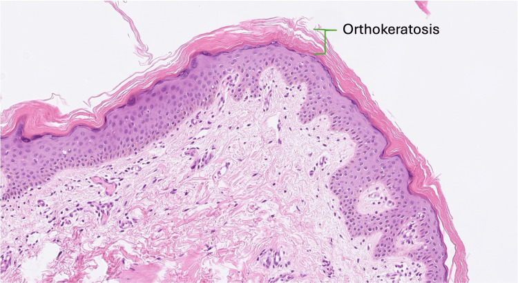 图3. 鱼鳞病皮肤活检的组织病理学。