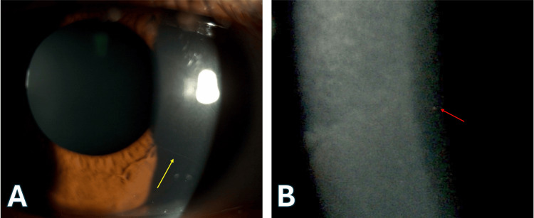 图2. 明显的角膜神经和点状深层基质混浊。