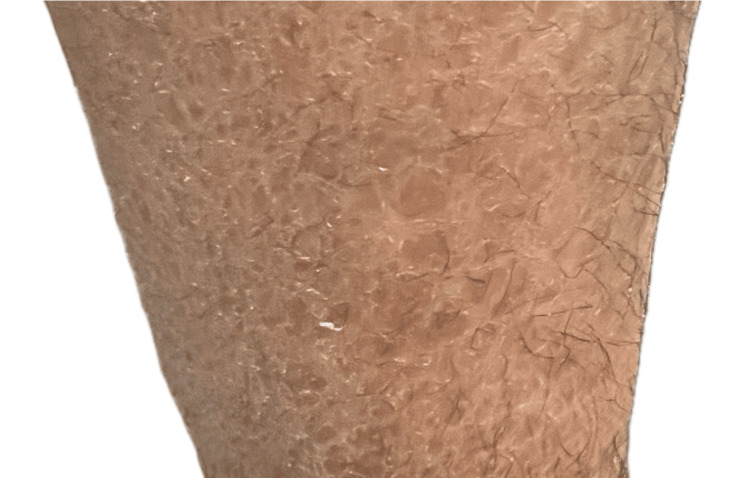 图1:图1. 下肢出现多边形、暗色、鳞状斑块伴增厚斑块。