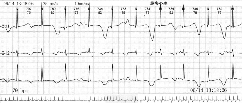 心源性通猝死基因检测在天津